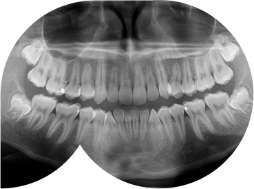 Panoramic Radiograph